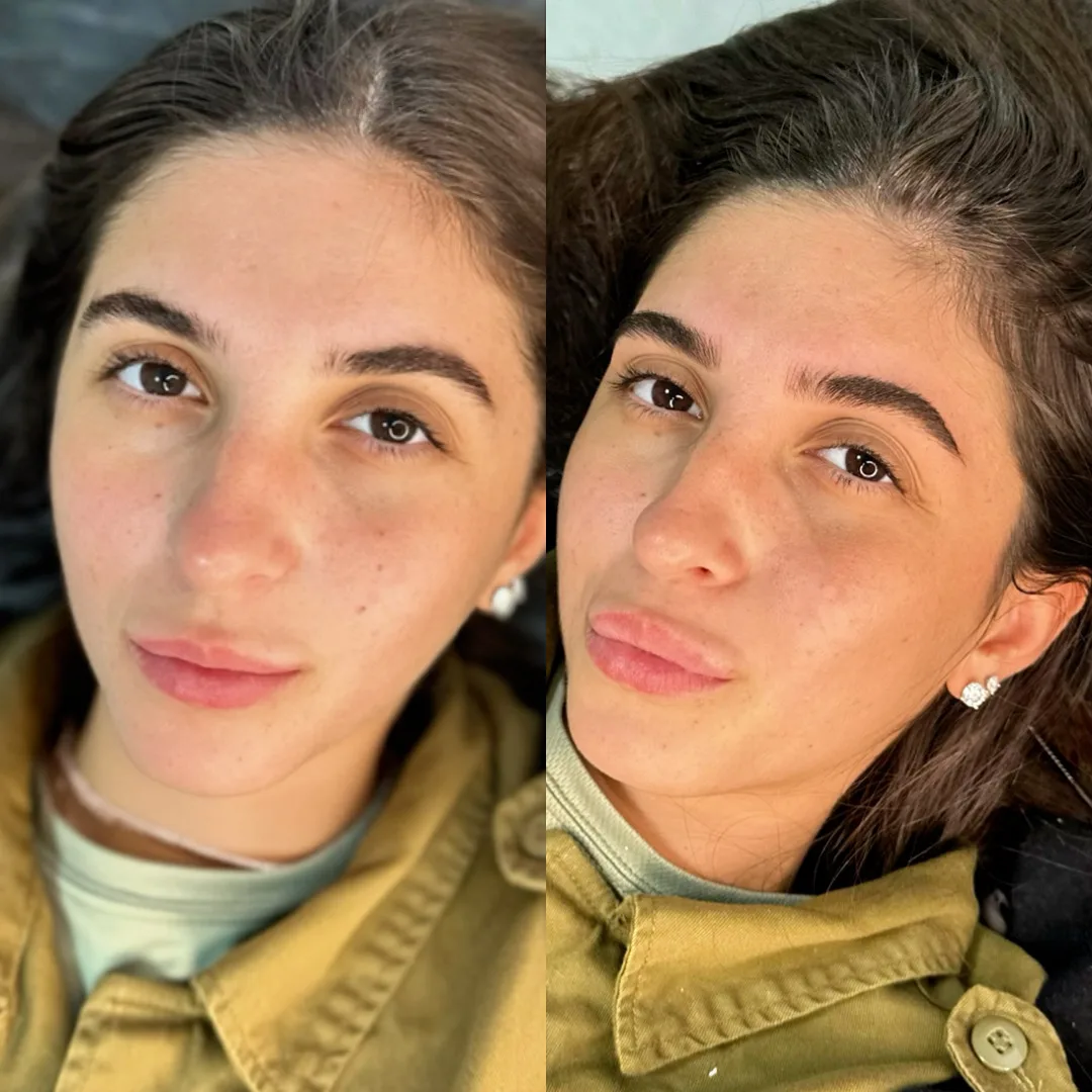 מיקרובליידינג לפני ואחרי 12